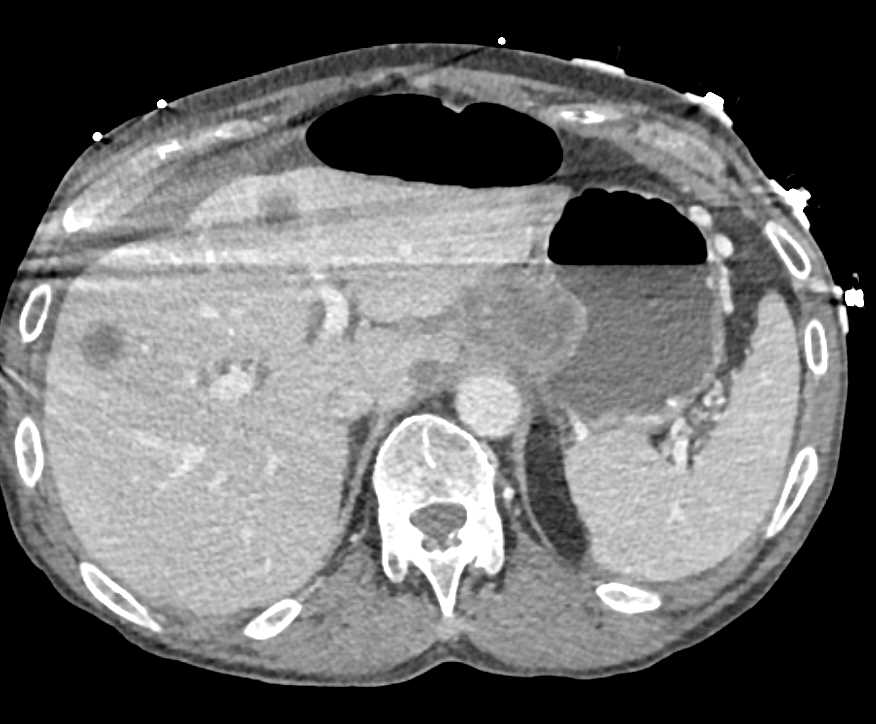 Pneumatosis Right Colon in Patient with Cancer at Gastroesophageal (GE) Junction with Liver Metastases - CTisus CT Scan