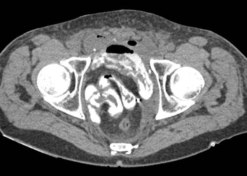 Rectal Contrast Colon without Extravasation - CTisus CT Scan