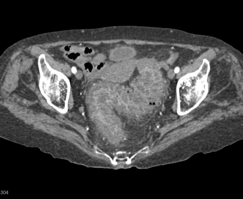 Pseudomembranous Colitis Best Defined in Sigmoid Colon - CTisus CT Scan