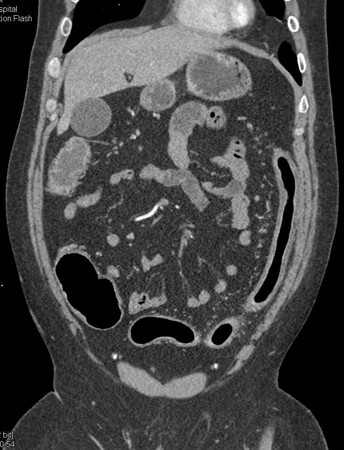 Ulcerative Colitis with Prominent Vascular Vasa Recta - CTisus CT Scan