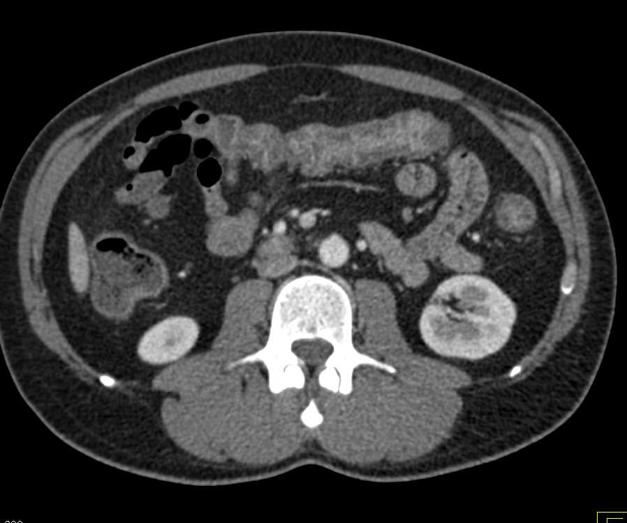 Ulcerative Colitis Best Seen in the Descending Colon - CTisus CT Scan