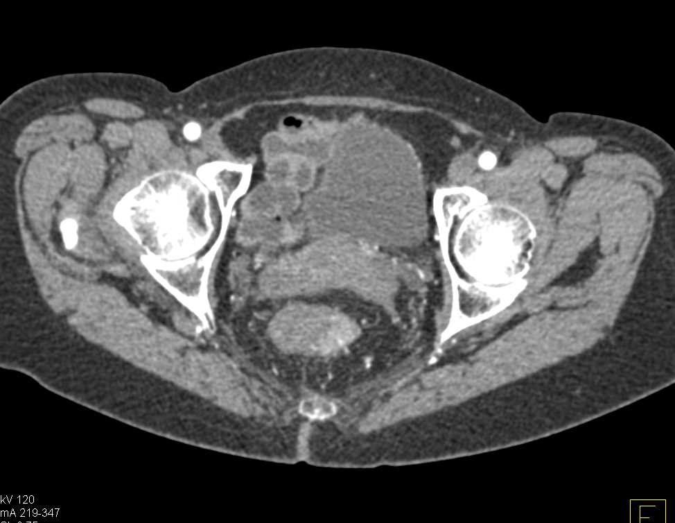 Rectal Cancer - CTisus CT Scan