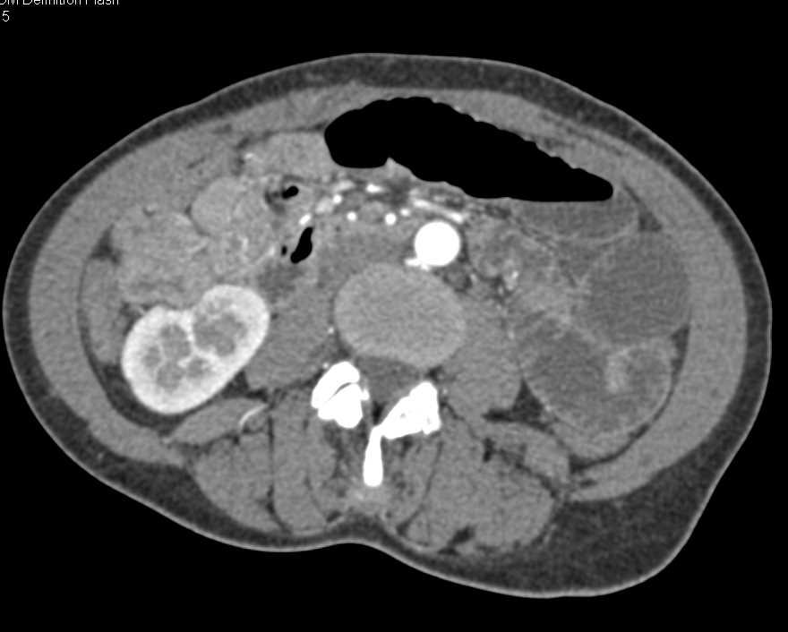 Small Bowel Obstruction (SBO) with Distal Small Bowel Obstruction - CTisus CT Scan