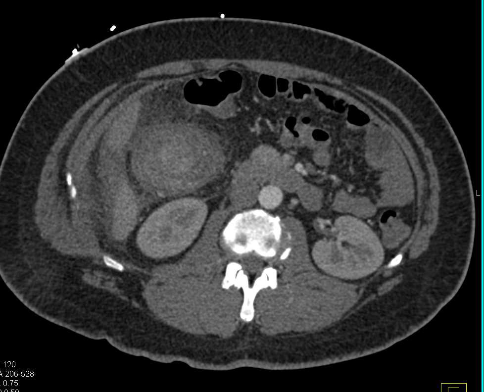 Right Colon Cancer with Carcinomatosis - CTisus CT Scan