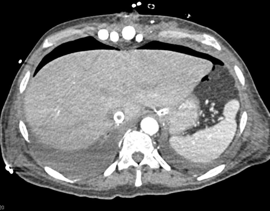 Colitis Involves Distal Colon with Pneumoperitoneum - CTisus CT Scan