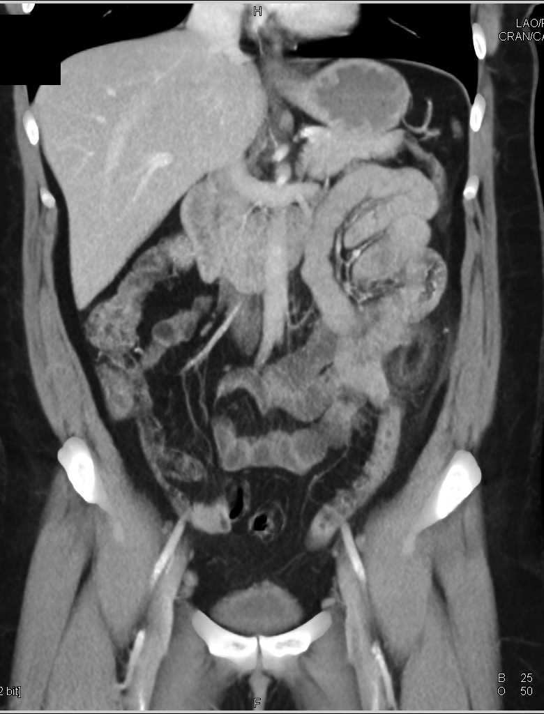 Diverticulitis with Abscess - CTisus CT Scan