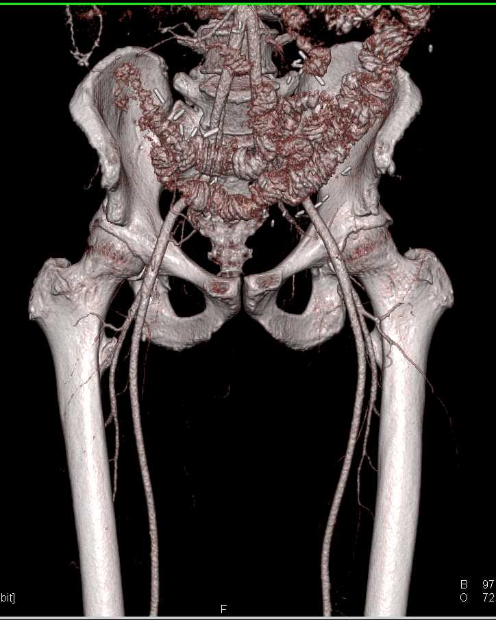 Recurrent Rectal Cancer with Vascular Mapping - CTisus CT Scan
