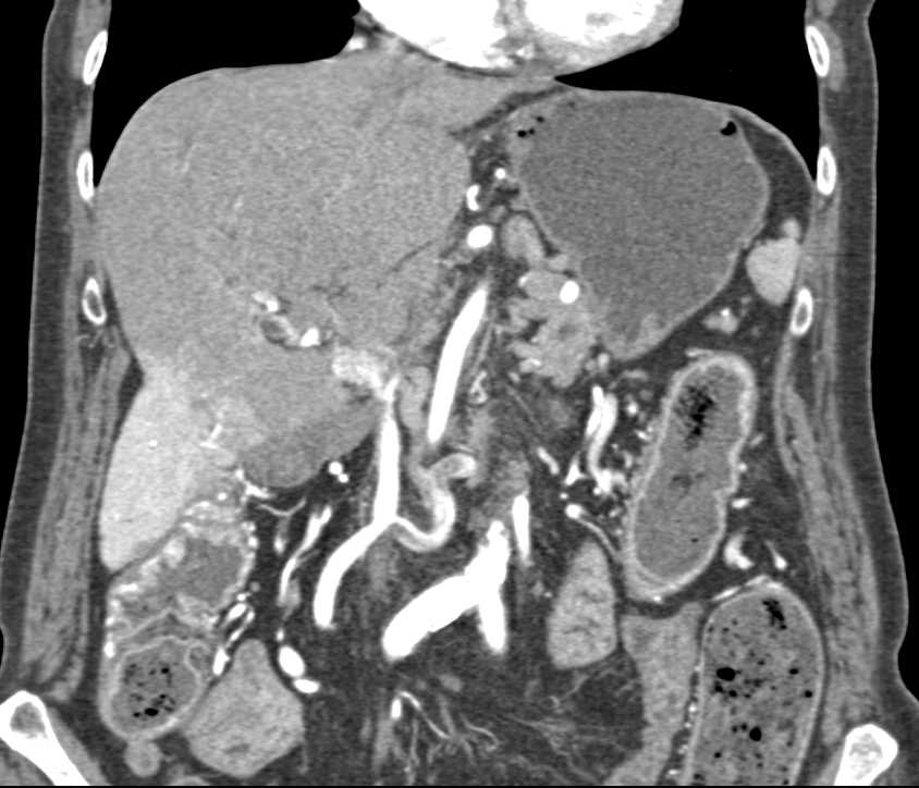 Angiodysplasia of the Right Colon - CTisus CT Scan