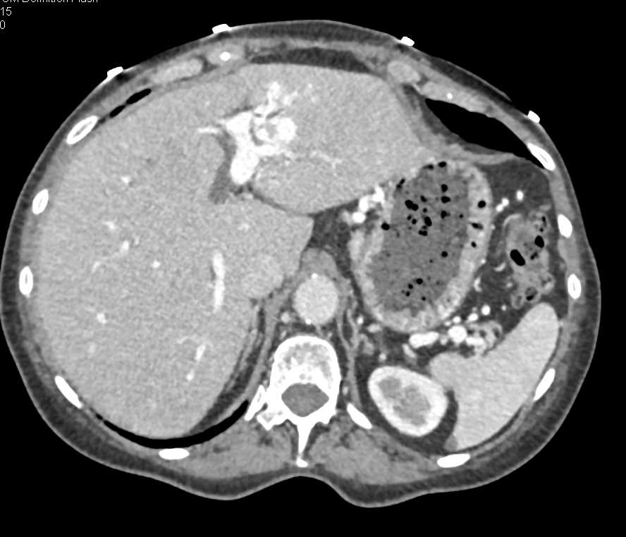 Angiodysplasia of the Right Colon and Cavernous Transformation of the Portal Vein - CTisus CT Scan