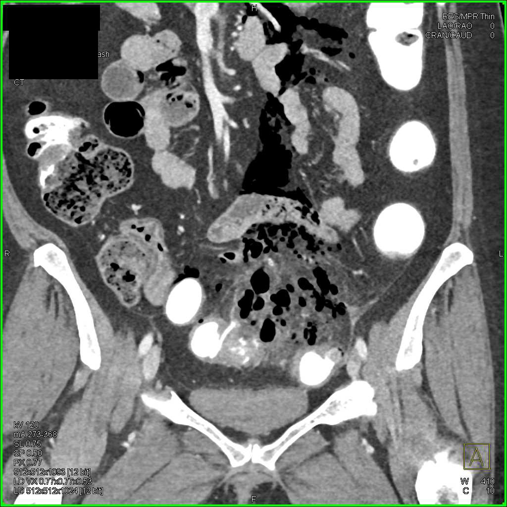 Diverticulitis with Abscess and Inflammation in Sigmoid Colon - CTisus CT Scan
