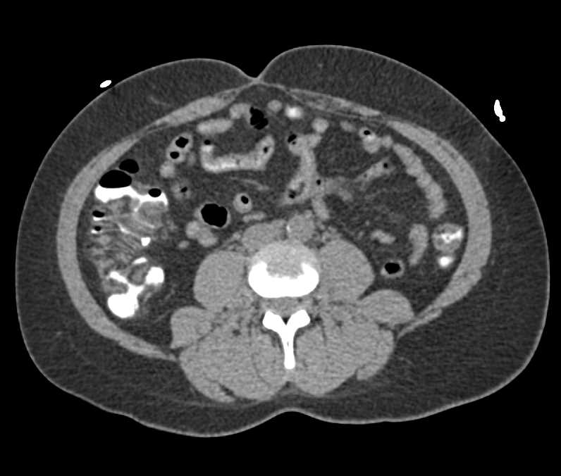 Ulcerative Colitis - CTisus CT Scan