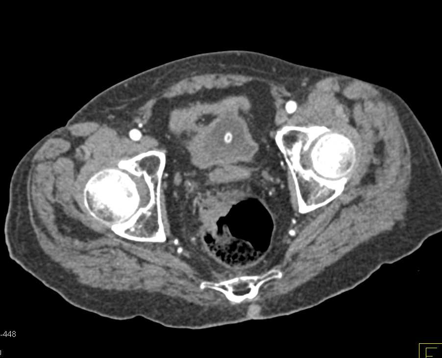 Infiltrating Rectal Cancer - CTisus CT Scan