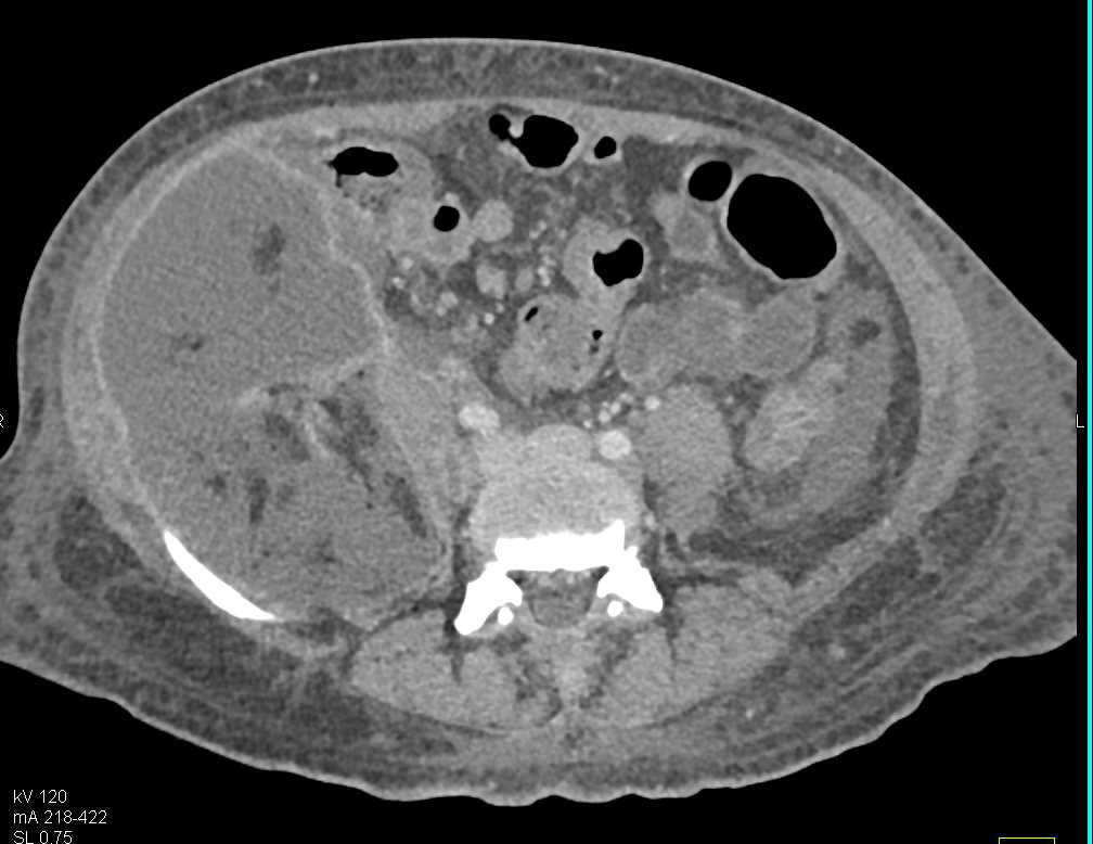 Perforated Appendix with Abscess - CTisus CT Scan