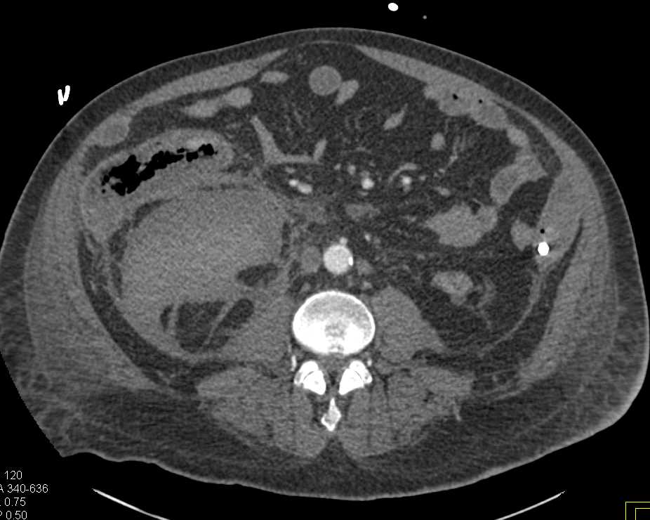 Pneumatosis Right Colon with Bleed Near Right Kidney - CTisus CT Scan