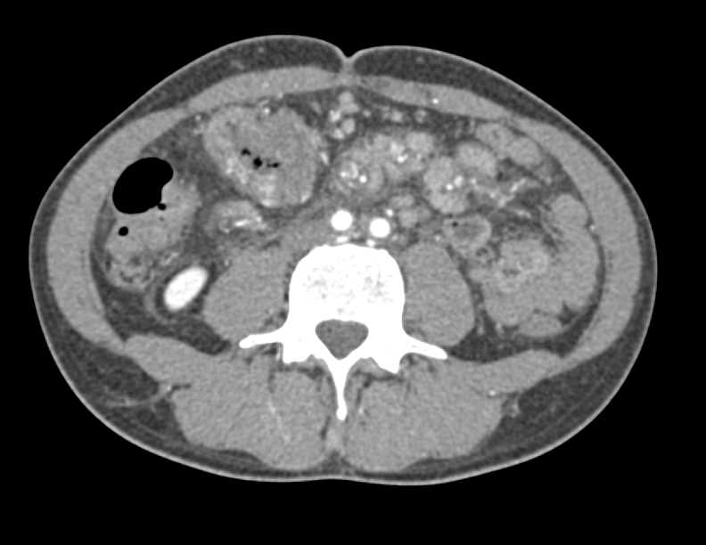 Metastatic Carcinoma of the Right Colon - CTisus CT Scan