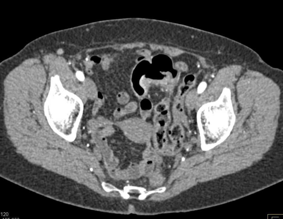 Apple Core Lesion in the Sigmoid Colon - CTisus CT Scan