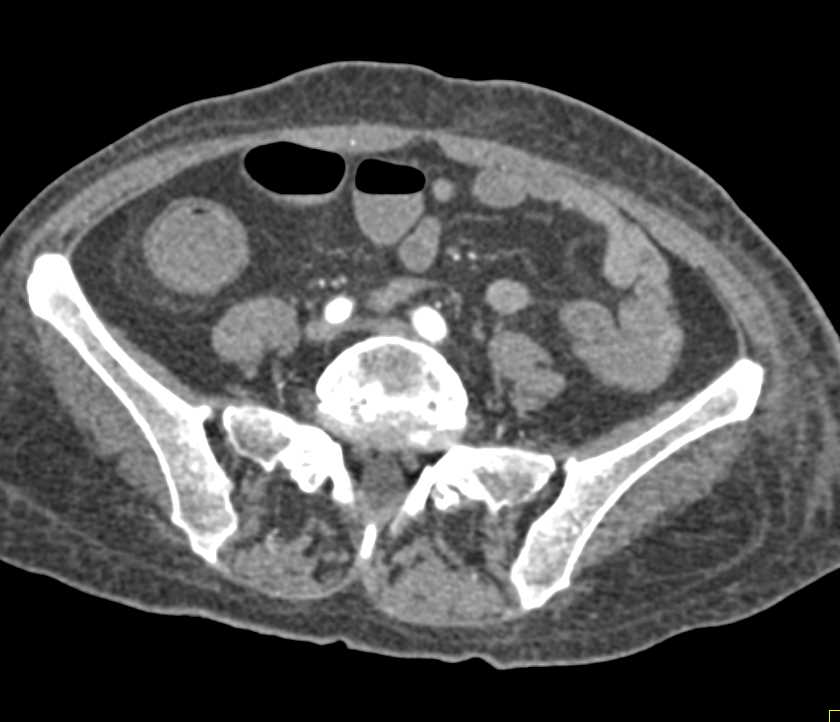 Active Bleed Right Colon Seen Changing from Arterial to Venous Phase Imaging - CTisus CT Scan