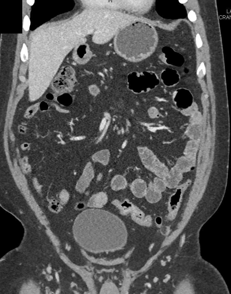 Omental Infarct Left Lower Quadrant - CTisus CT Scan