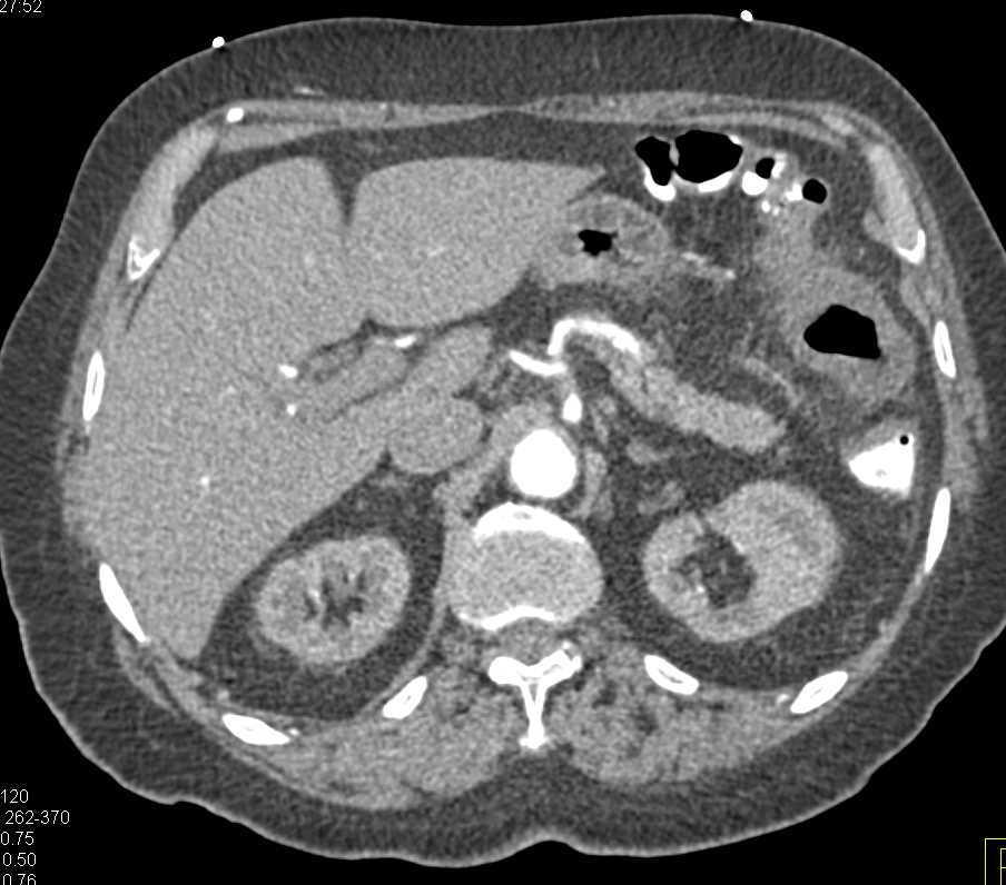 Ischemic Colitis Splenic Flexure - CTisus CT Scan