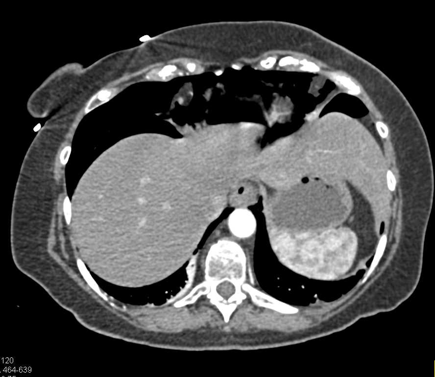 Pneumoperitoneum Due to Perforated Colon - CTisus CT Scan