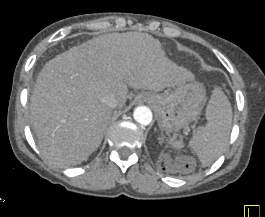 Cirrhosis and Portal Hypertension with Thickened Colon - CTisus CT Scan