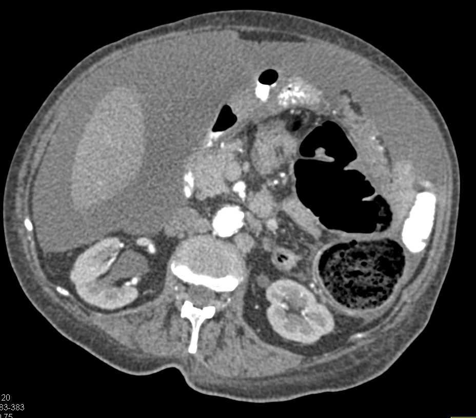 Colon Cancer with Extensive Ascites - CTisus CT Scan
