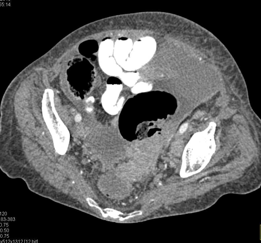 Colon Cancer with Extensive Ascites - CTisus CT Scan