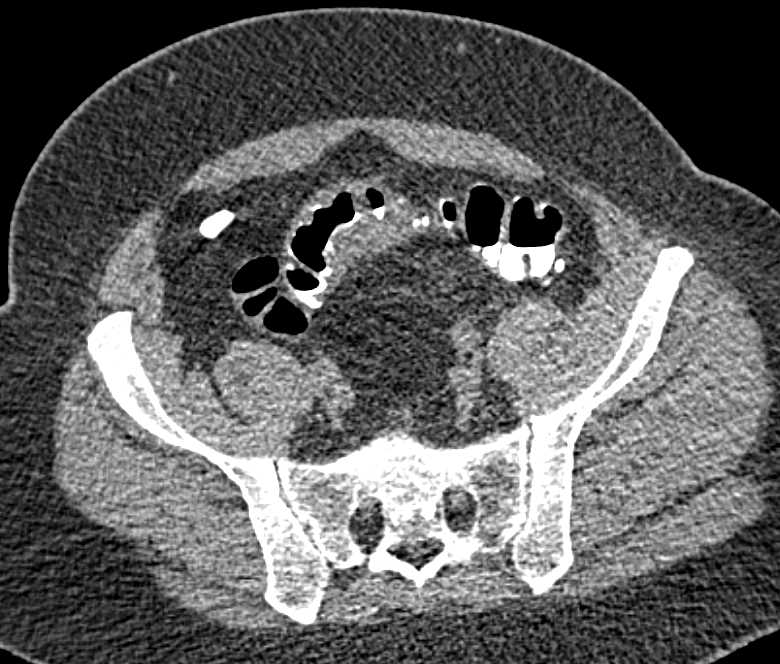 Positive Contrast in Virtual Colonoscopy - CTisus CT Scan