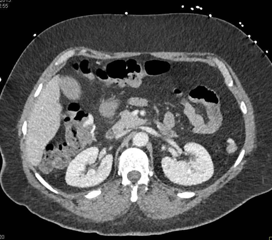 Gastrointestinal (GI) Bleed in Hepatic Flexure - CTisus CT Scan
