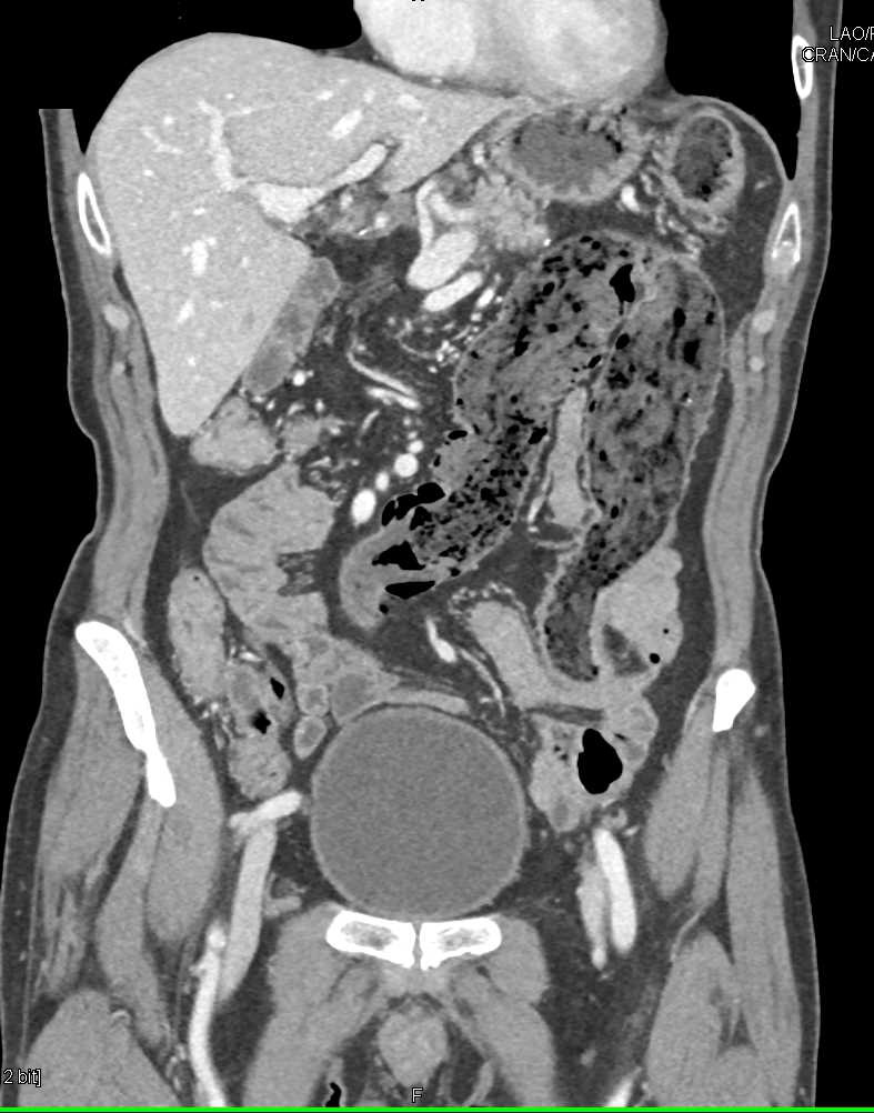 Infectious Colitis - CTisus CT Scan