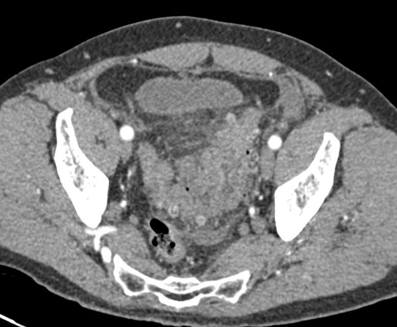 Focal Sigmoid Diverticulitis with Perforation - CTisus CT Scan