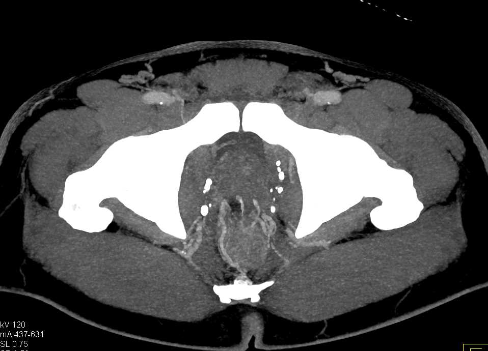 Gastrointestinal (GI) Bleed due to Rectal Varices - CTisus CT Scan