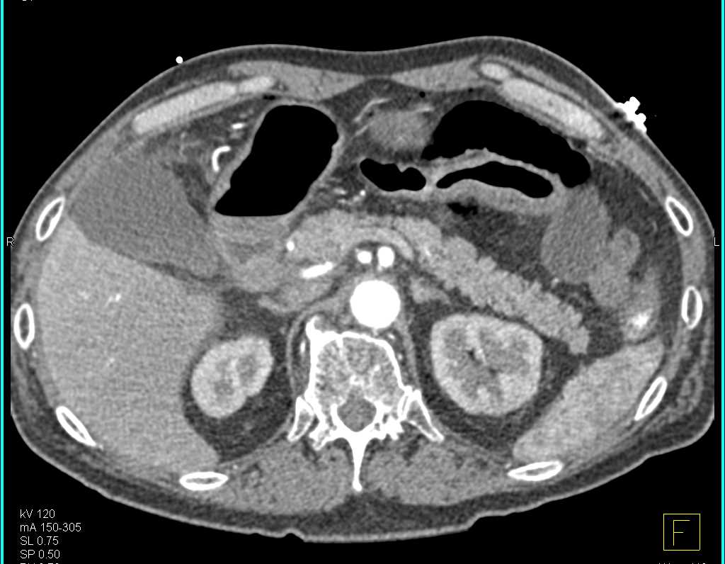 Pseudomembranous Colitis Right Colon - CTisus CT Scan