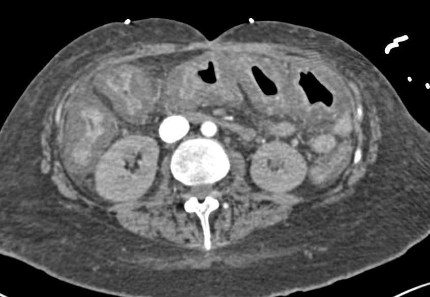 Pseudomembranous Colitis (PMC) - CTisus CT Scan