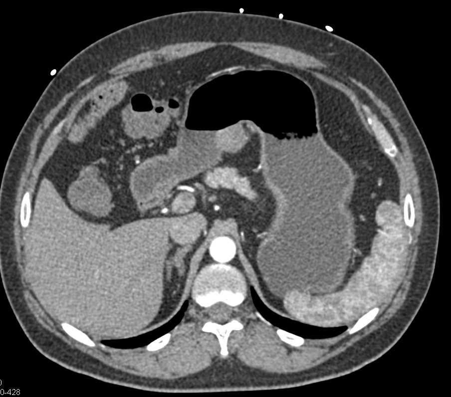 Colitis Right Colon - CTisus CT Scan