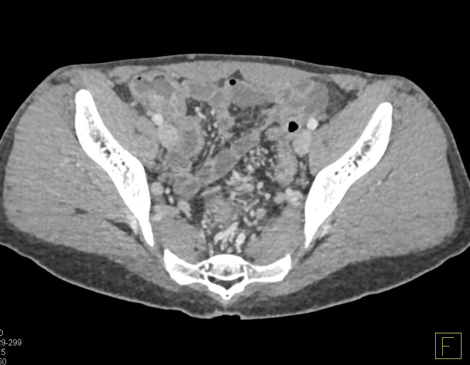 Colitis Involves the Rectum - CTisus CT Scan