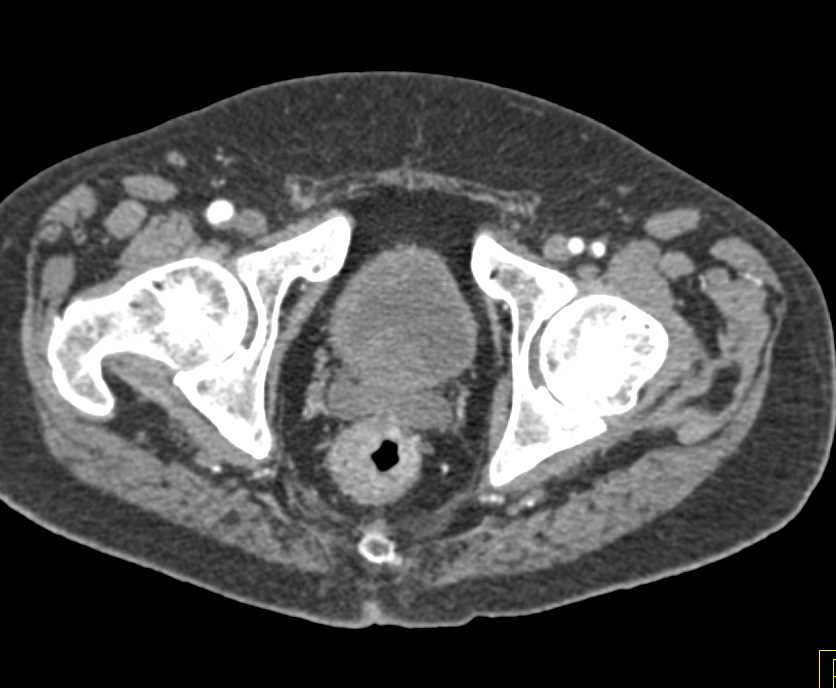 Rectal Cancer in a Patient with a History of Ulcerative Colitis - CTisus CT Scan