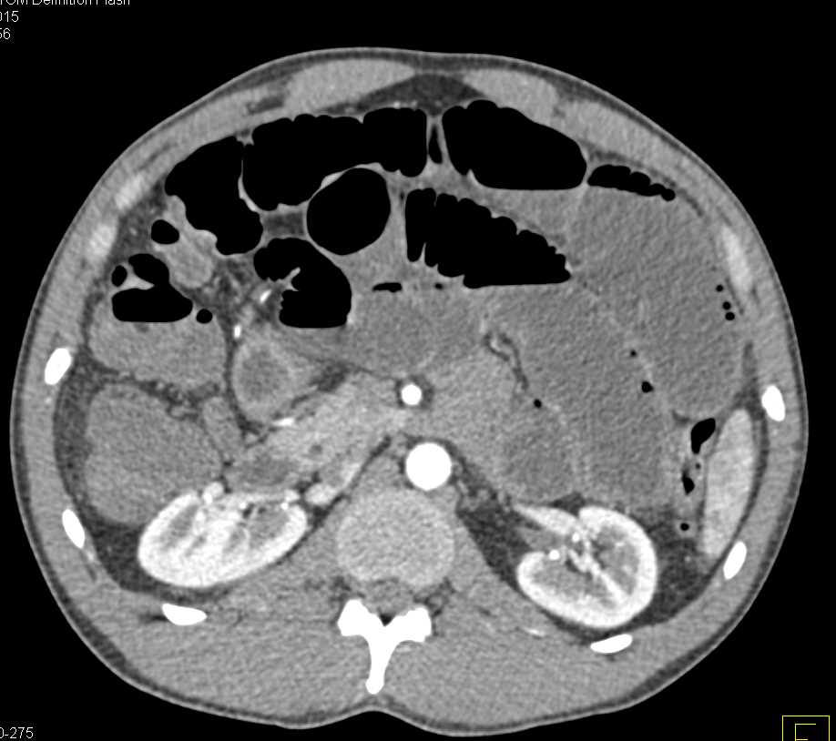 Cecal Diverticulitis Cases Small Bowel Obstruction (SBO) - CTisus CT Scan