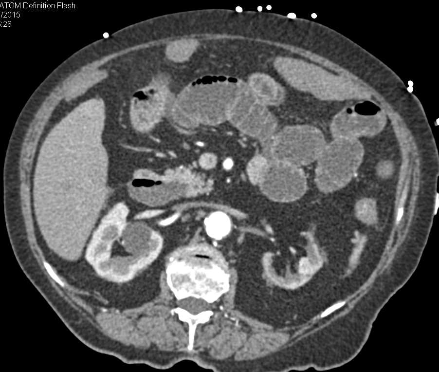 Small Bowel Obstruction (SBO) due to Cecal Volvulus - CTisus CT Scan