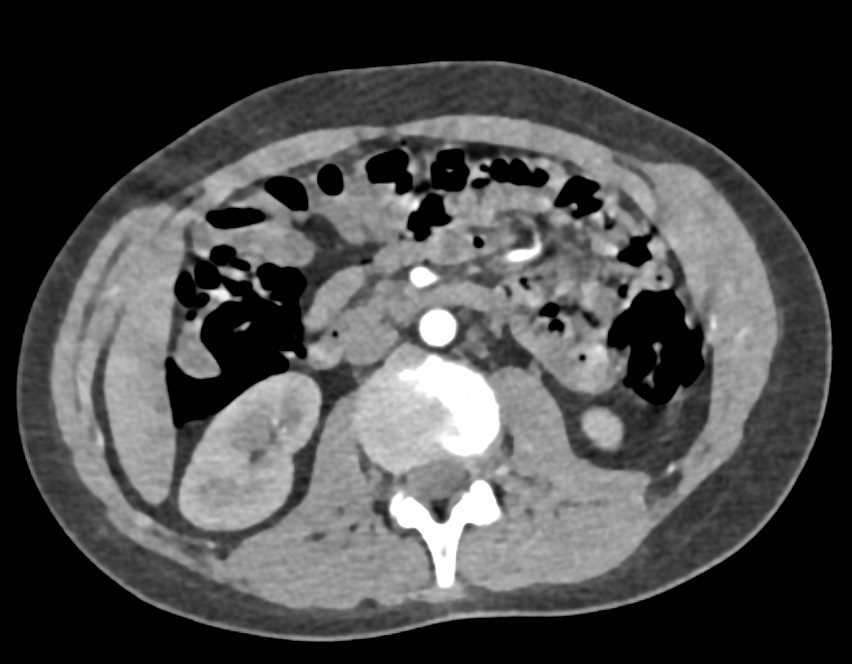Benign Pneumatosis Colon - CTisus CT Scan