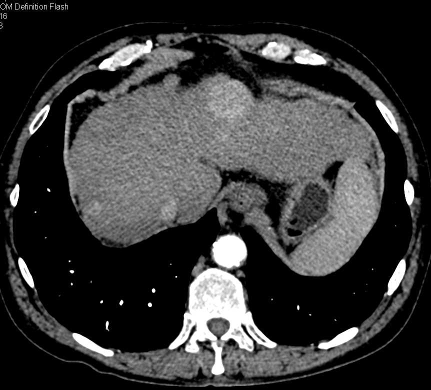 Rectal Varices in a Patient with Cirrhosis and Hepatocellular Carcinoma (Hepatoma) - CTisus CT Scan