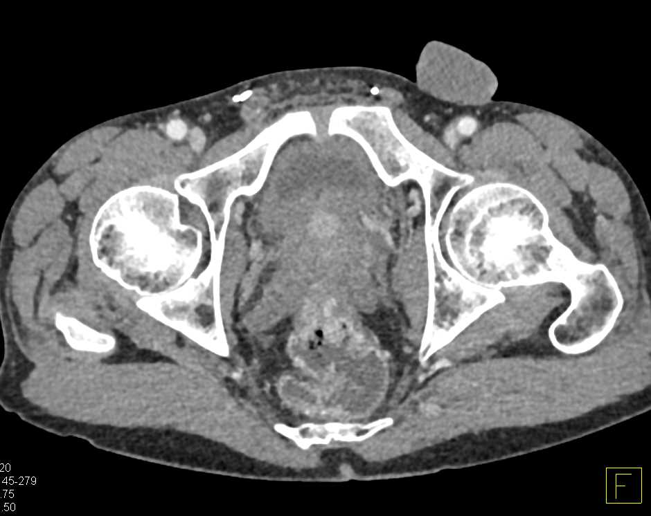 Rectal Cancer - CTisus CT Scan