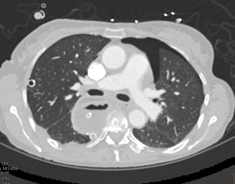 Extensive Pneumatosis Right Colon Following Esophageal Surgery - CTisus CT Scan