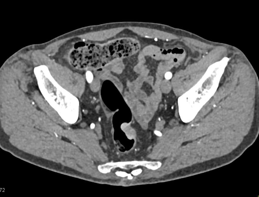 Rectal Cancer - CTisus CT Scan