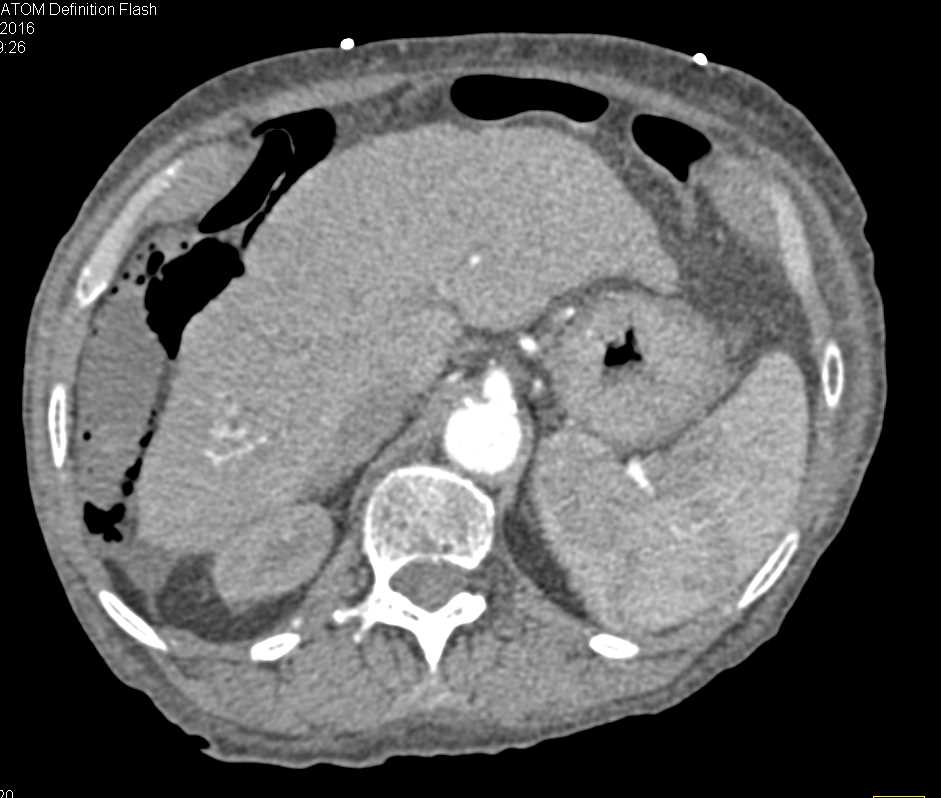 Pneumatosis Colon in Patient with Cirrhosis - CTisus CT Scan