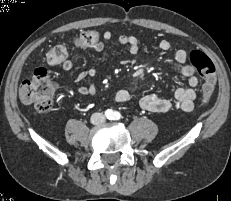 Prominent Enhancement Rectum with Changes Compatible with Colitis and Gastrointestinal (GI) Bleed - CTisus CT Scan