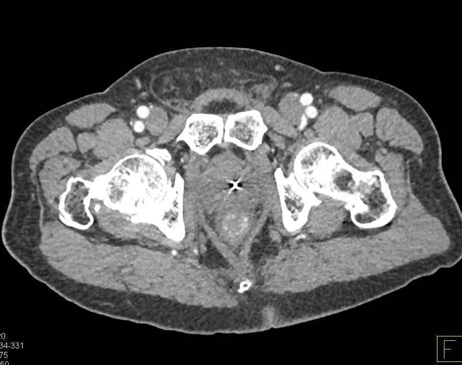 Colitis Rectum and Sigmoid Colon - CTisus CT Scan