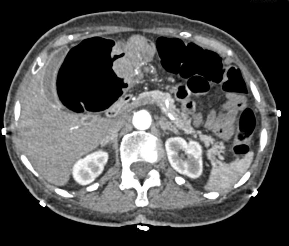 Carcinoma Hepatic Flexure Obstructs the Bowel - CTisus CT Scan
