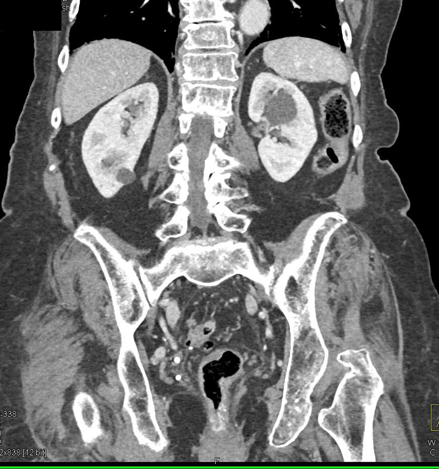 Rectal Varices - CTisus CT Scan