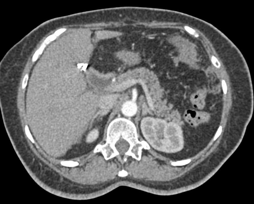 Colon Cancer with Carcinomatosis - CTisus CT Scan